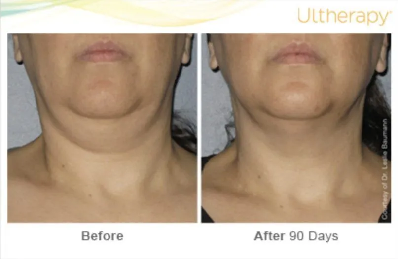 Before and 90 days after ultherapy